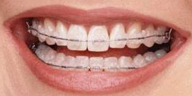 orthodontie adulte exemple