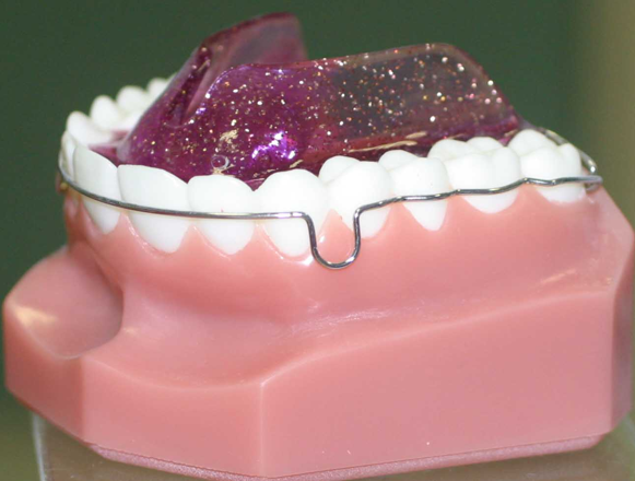 Appareil orthodontique fixe