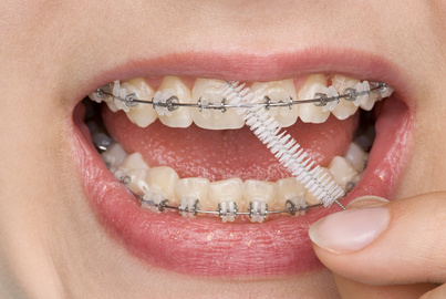 hygiène dentaire et orthodontie